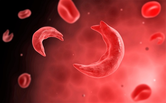 Pfizer, NNPA Collaborate to Raise Awareness of Sickle Cell Disease and Need for Improved Patient Care